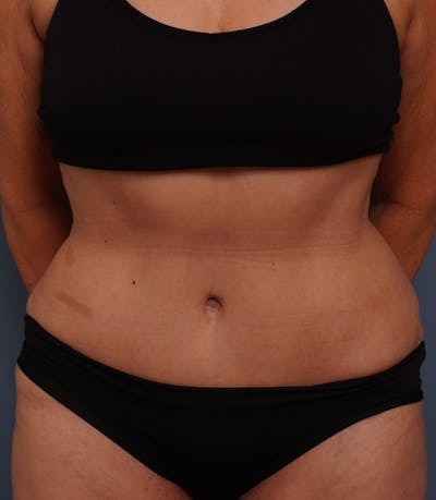 Tummy Tuck Before & After Gallery - Patient 388894 - Image 2