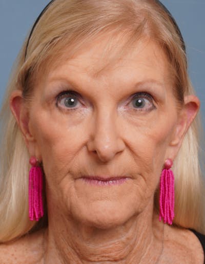 Facial Fat Transfer Before & After Gallery - Patient 452437 - Image 1