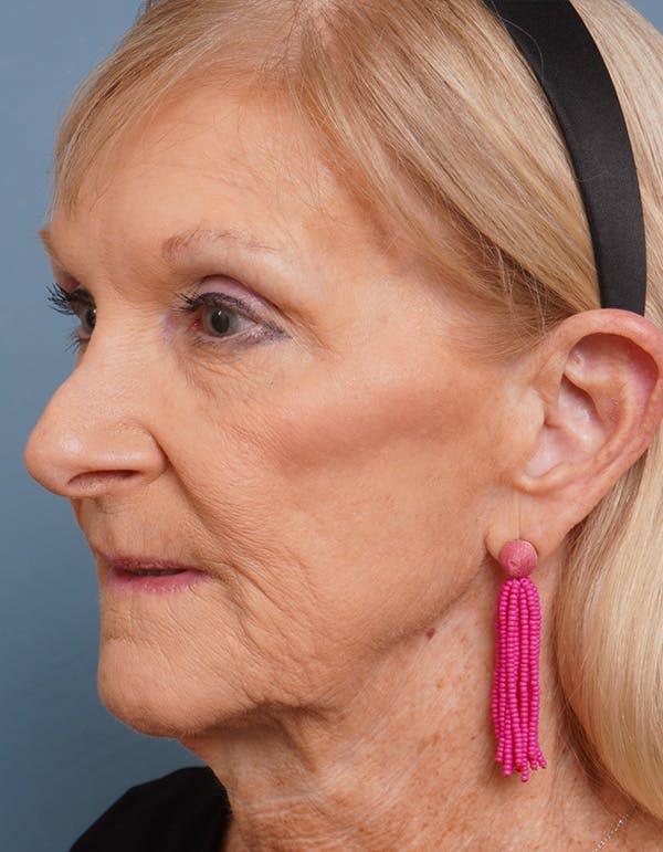 Facial Fat Transfer Before & After Gallery - Patient 452437 - Image 5