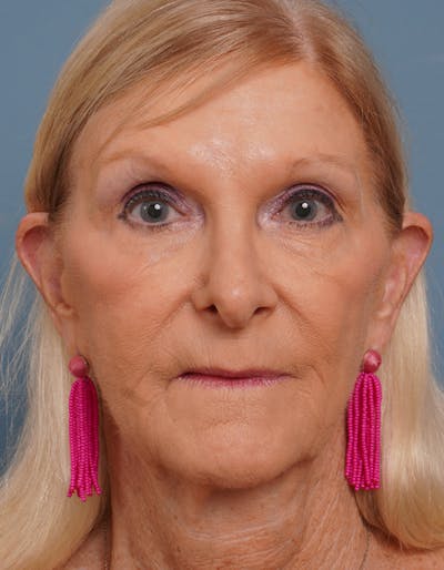 Facial Fat Transfer Before & After Gallery - Patient 452437 - Image 2