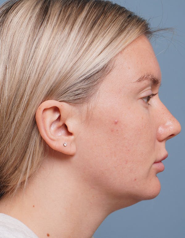 Liposuction Before & After Gallery - Patient 320338 - Image 3