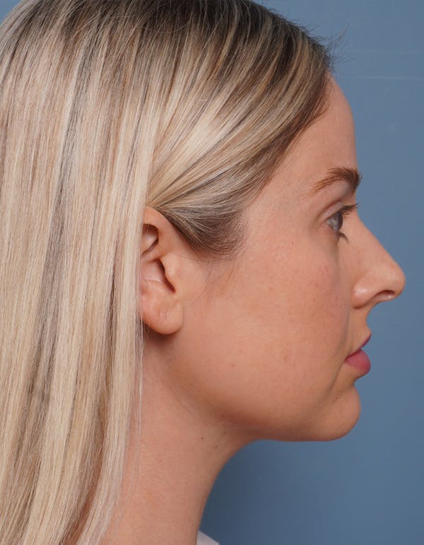 MyEllevate™ Before & After Gallery - Patient 715824 - Image 4
