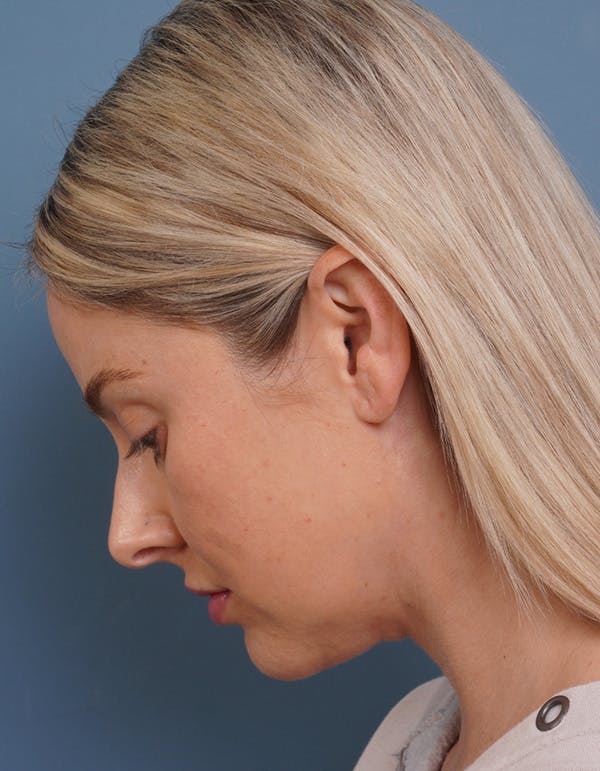 MyEllevate™ Before & After Gallery - Patient 715824 - Image 10