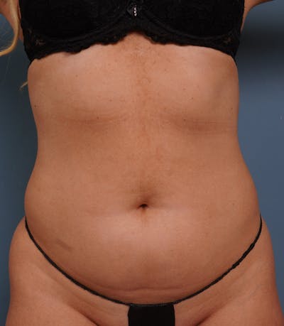 Liposuction Before & After Gallery - Patient 410367 - Image 1