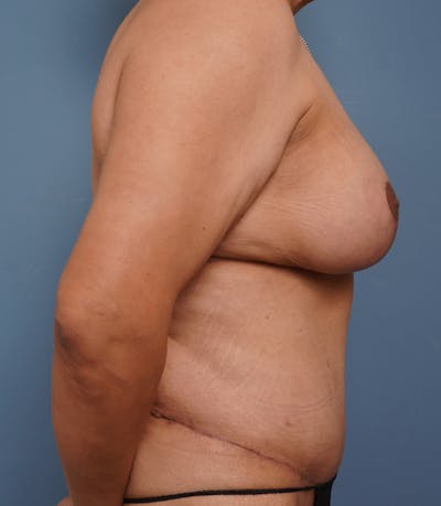 Tummy Tuck Before & After Gallery - Patient 424551 - Image 6