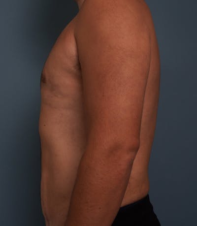 Liposuction Before & After Gallery - Patient 154439 - Image 10
