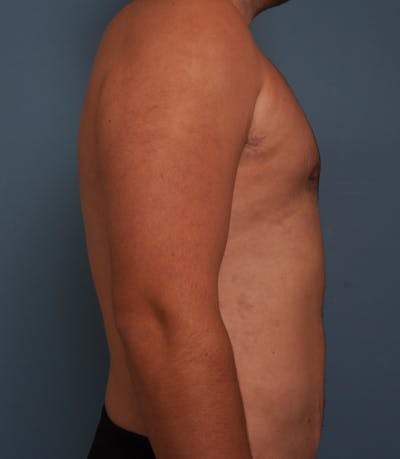 Liposuction Before & After Gallery - Patient 154439 - Image 6