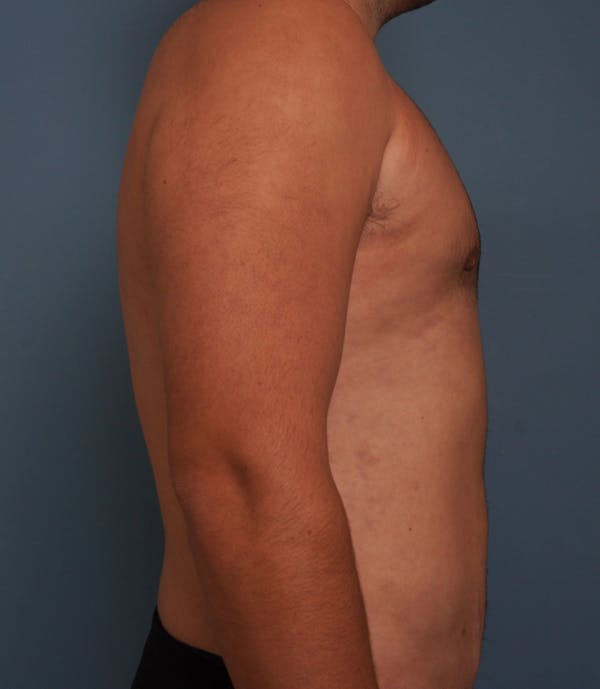 Liposuction Before & After Gallery - Patient 154439 - Image 6