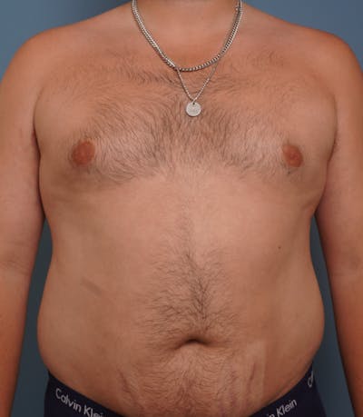 Liposuction Before & After Gallery - Patient 154439 - Image 1