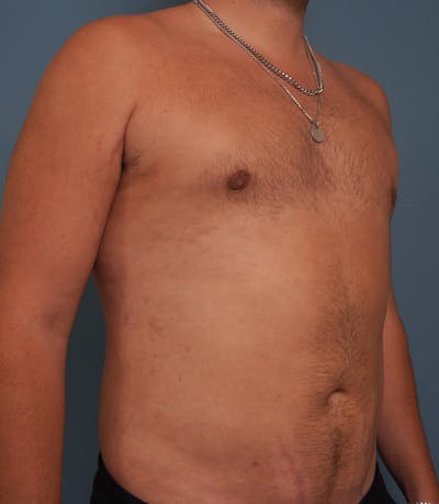 Liposuction Before & After Gallery - Patient 154439 - Image 4