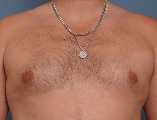 Gynecomastia Before & After Gallery - Patient 409542 - Image 1