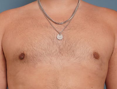 Gynecomastia Before & After Gallery - Patient 409542 - Image 2