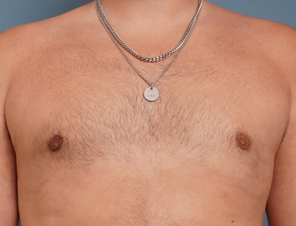 Gynecomastia Before & After Gallery - Patient 409542 - Image 2