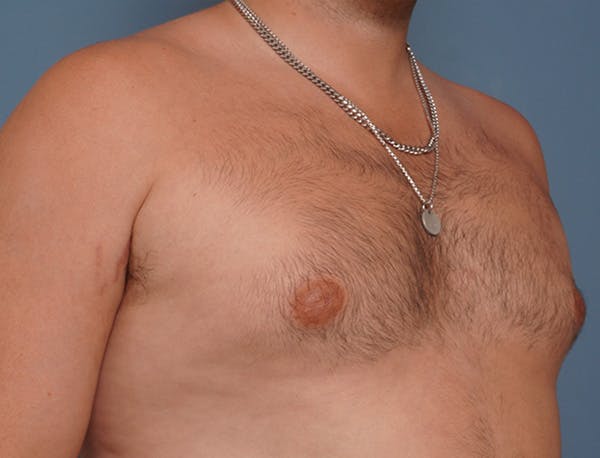Gynecomastia Before & After Gallery - Patient 409542 - Image 3
