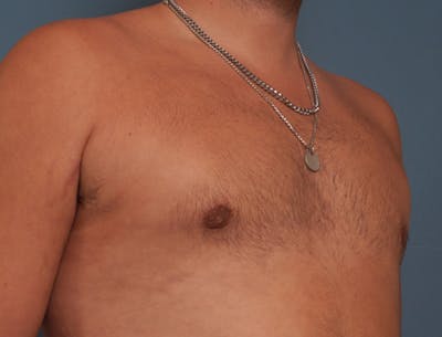 Gynecomastia Before & After Gallery - Patient 409542 - Image 4
