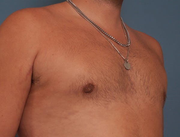 Gynecomastia Before & After Gallery - Patient 409542 - Image 4