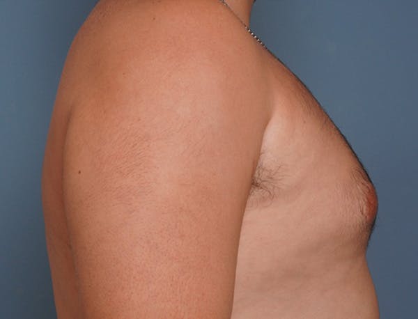 Gynecomastia Before & After Gallery - Patient 409542 - Image 5