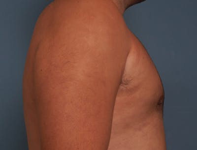 Gynecomastia Before & After Gallery - Patient 409542 - Image 6