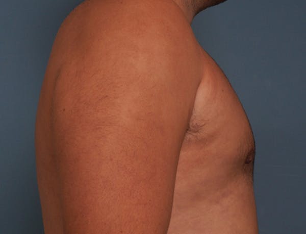 Gynecomastia Before & After Gallery - Patient 409542 - Image 6