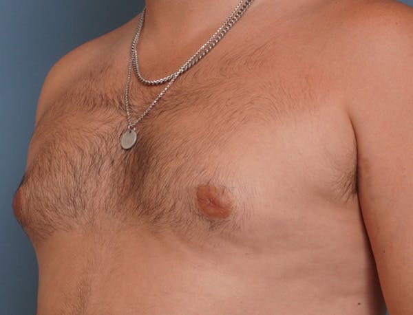 Gynecomastia Before & After Gallery - Patient 409542 - Image 7