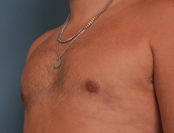 Gynecomastia Before & After Gallery - Patient 409542 - Image 8