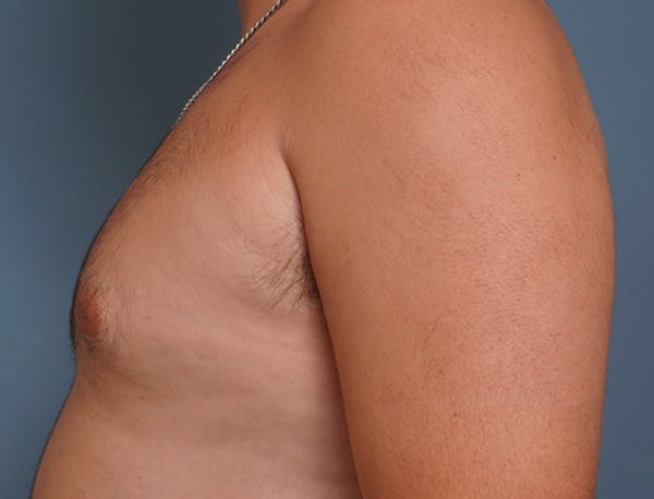 Gynecomastia Before & After Gallery - Patient 409542 - Image 9