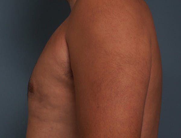 Gynecomastia Before & After Gallery - Patient 409542 - Image 10