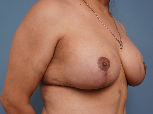 Breast Augmentation Before & After Gallery - Patient 903599 - Image 4