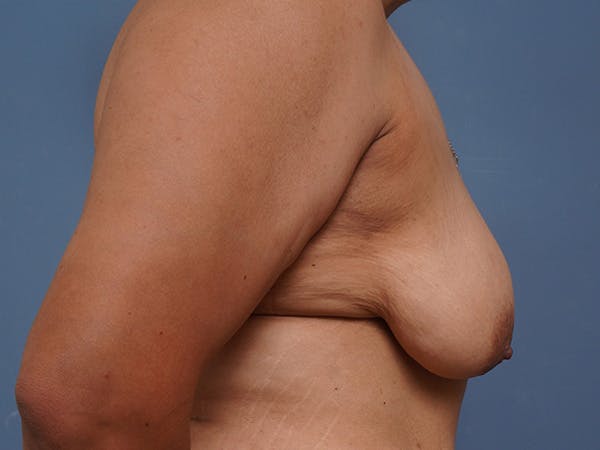 Breast Augmentation Before & After Gallery - Patient 903599 - Image 5