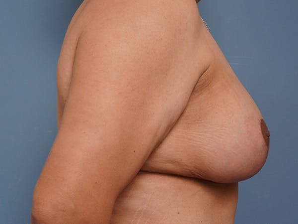 Breast Augmentation Before & After Gallery - Patient 903599 - Image 6