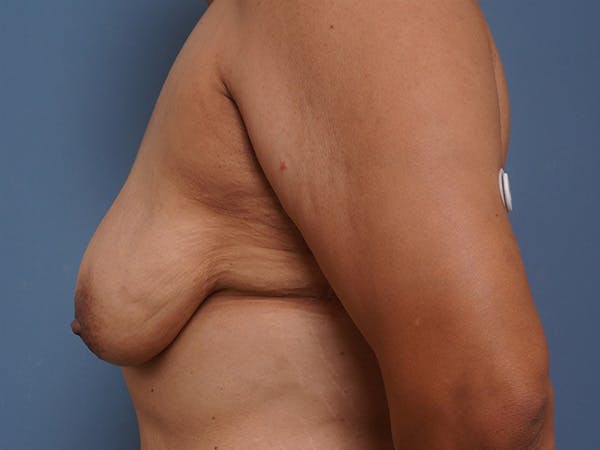 Breast Augmentation Before & After Gallery - Patient 903599 - Image 9