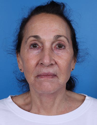 Facelift Before & After Gallery - Patient 120917 - Image 2