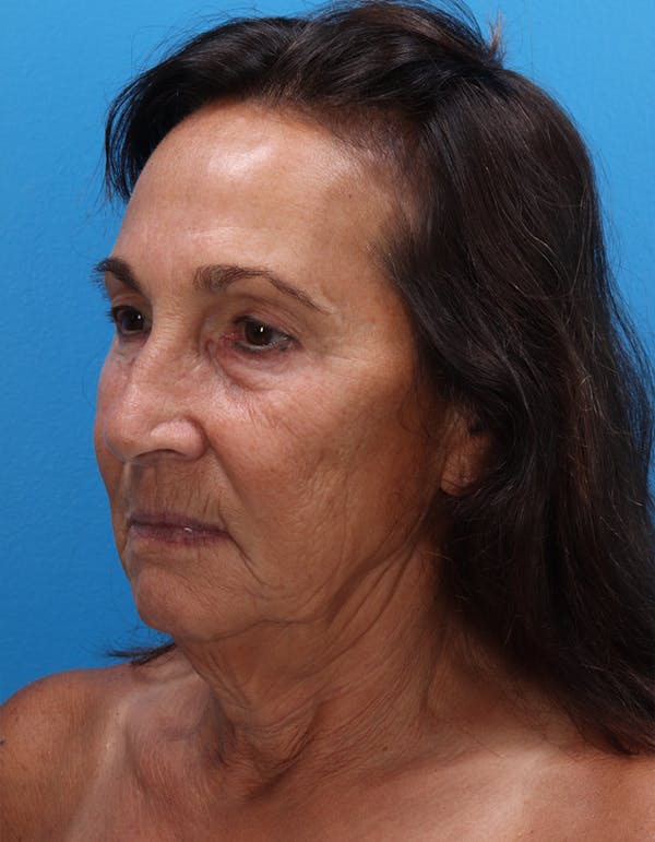 Facelift Before & After Gallery - Patient 120917 - Image 3
