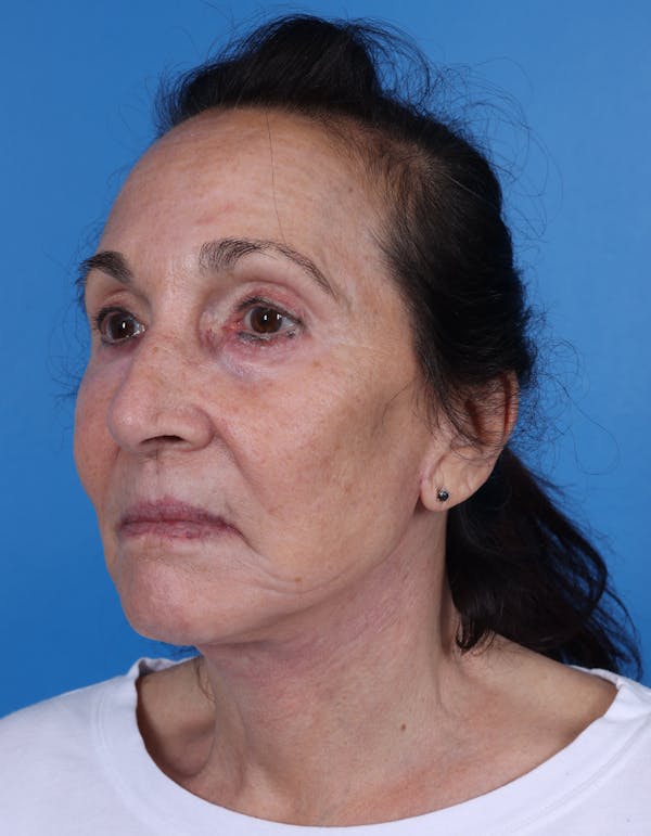 Facelift Before & After Gallery - Patient 120917 - Image 4