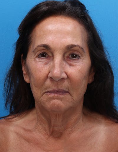 Facelift Before & After Gallery - Patient 120917 - Image 1