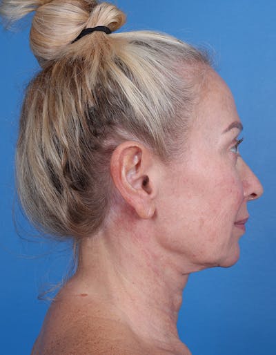 Neck Lift Before & After Gallery - Patient 134129 - Image 1
