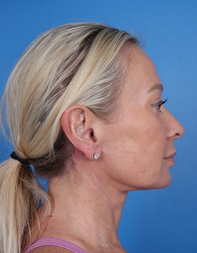 Neck Lift Before & After Gallery - Patient 134129 - Image 2