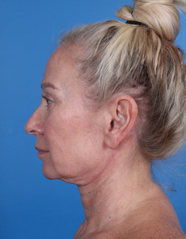 Neck Lift Before & After Gallery - Patient 134129 - Image 3