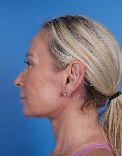 Neck Lift Before & After Gallery - Patient 134129 - Image 4