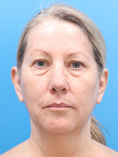 Blepharoplasty Before & After Gallery - Patient 225319 - Image 1