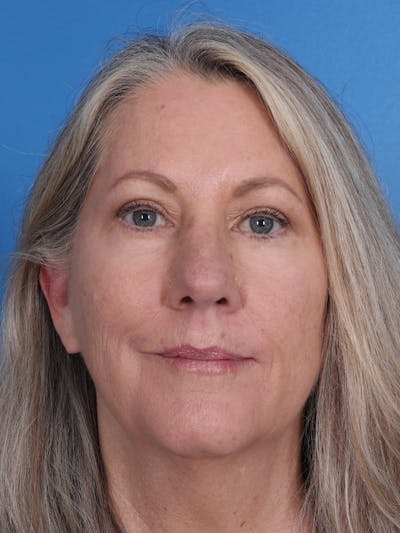 Blepharoplasty Before & After Gallery - Patient 225319 - Image 2