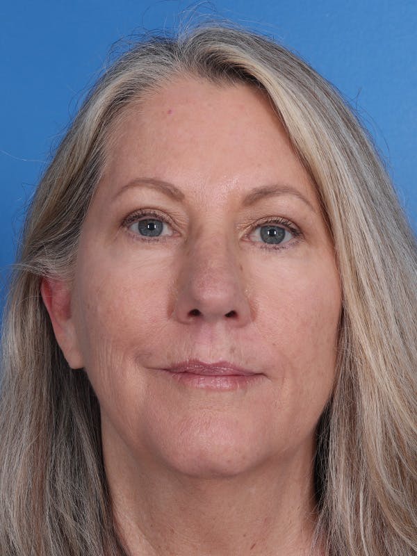 Blepharoplasty Before & After Gallery - Patient 225319 - Image 2