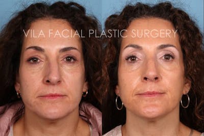 Rhinoplasty Before & After Gallery - Patient 20061759 - Image 1