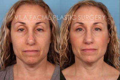 Rhinoplasty Before & After Gallery - Patient 20061760 - Image 1