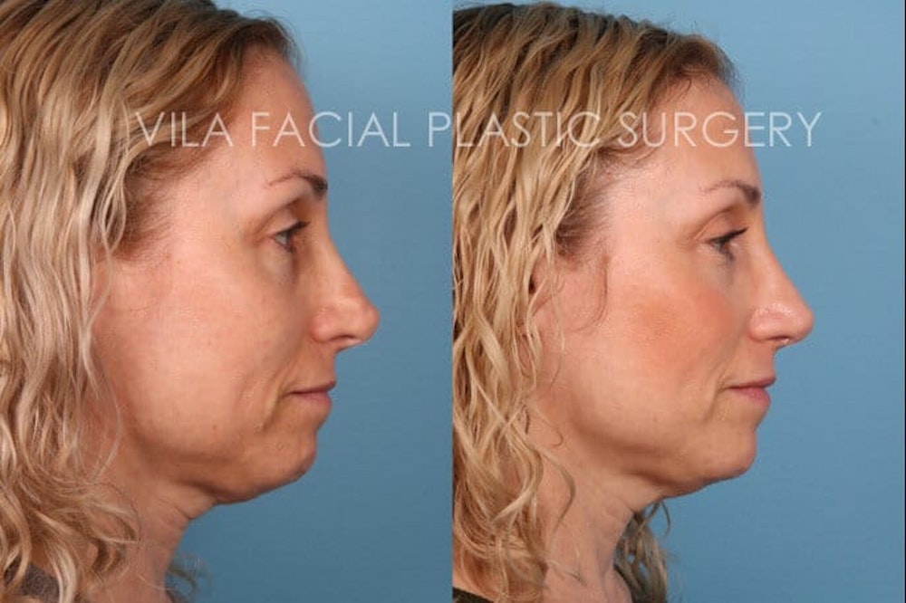 Rhinoplasty in Portland Before & After Photos by Dr. Vila