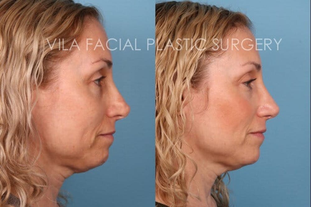 Rhinoplasty Before & After Gallery - Patient 20061760 - Image 2