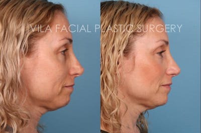 Rhinoplasty Before & After Gallery - Patient 20061760 - Image 2