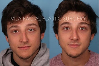 Rhinoplasty Before & After Gallery - Patient 20061761 - Image 1