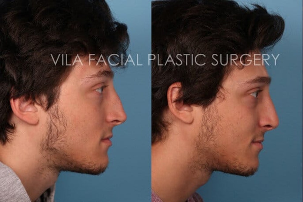 Rhinoplasty in Portland Before & After Photos by Dr. Vila