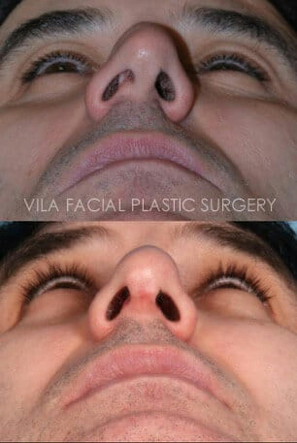 Rhinoplasty Before & After Gallery - Patient 20061762 - Image 1